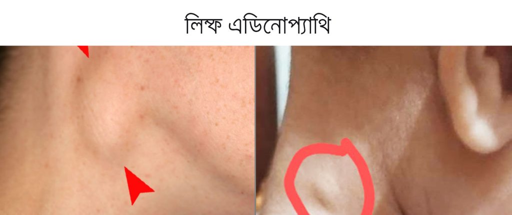 cervical lymphadenopathy