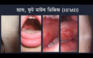 hfmd sq