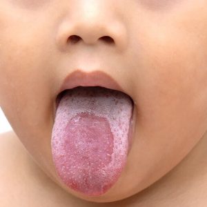 oral thrush b