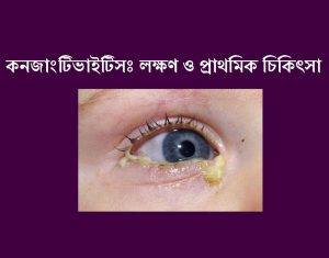 conjunctivitis f