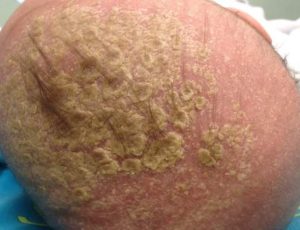 cradle cap 2