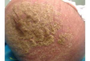 cradle cap 2