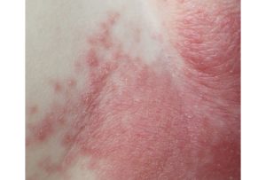 diaper rash2