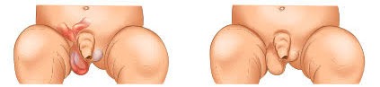 hernia