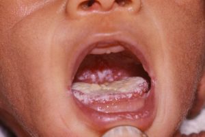 oral thrush 2