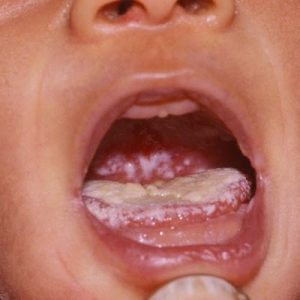oral thrush c