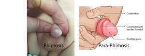 phimosis 2