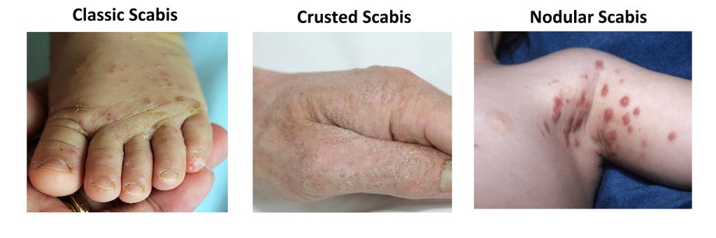 scabis