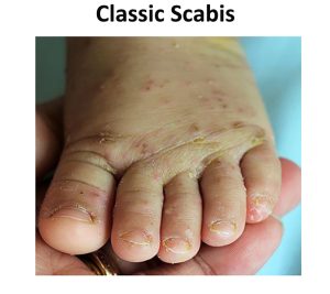 scabis 12