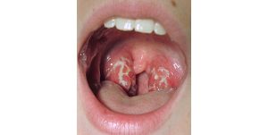 tonsillitis