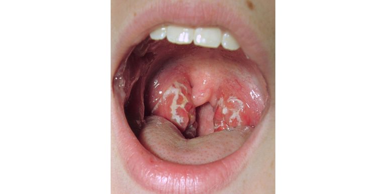 tonsillitis