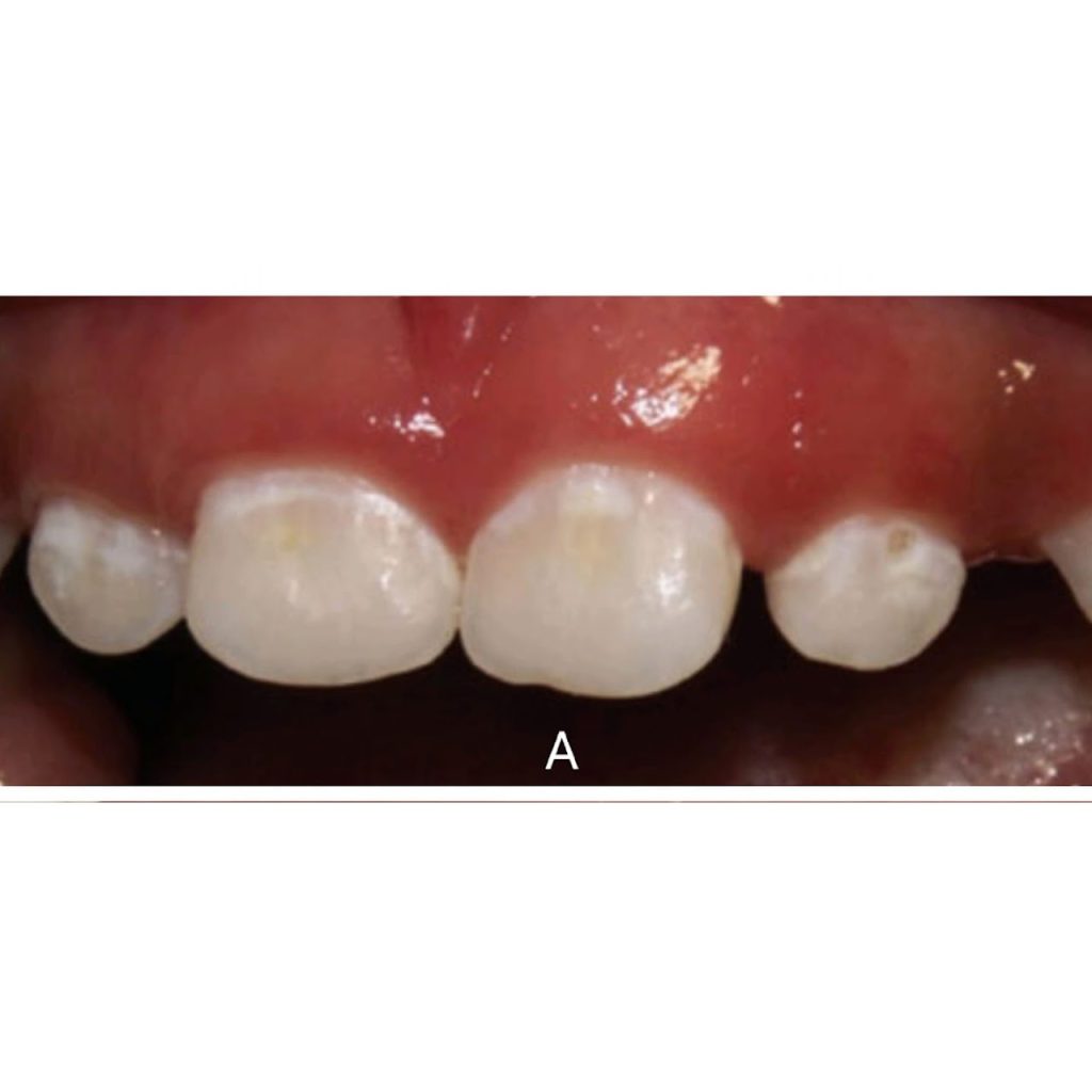 tooth decay a