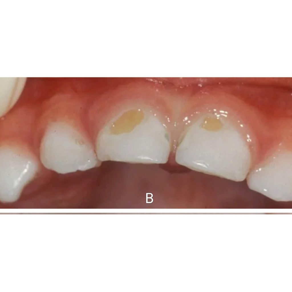 tooth decay b