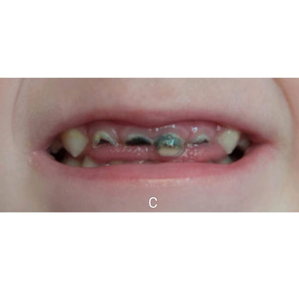 tooth decay c
