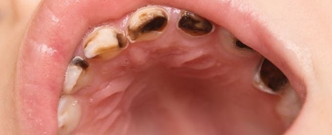 tooth decay